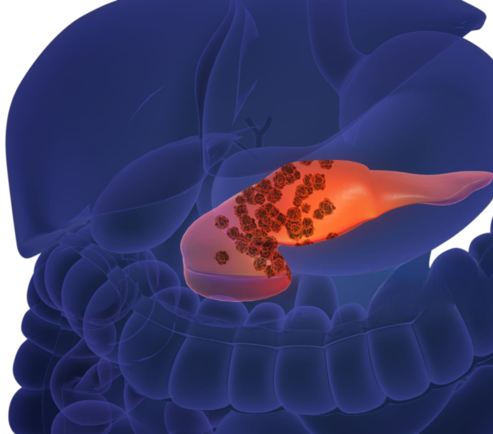 Types Of Pancreatic Surgery